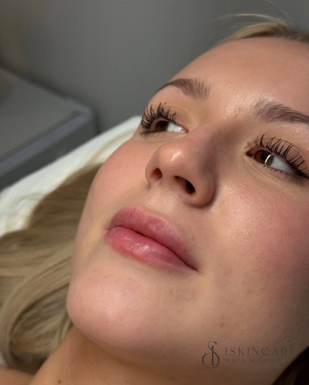 Natural lip enhancement result